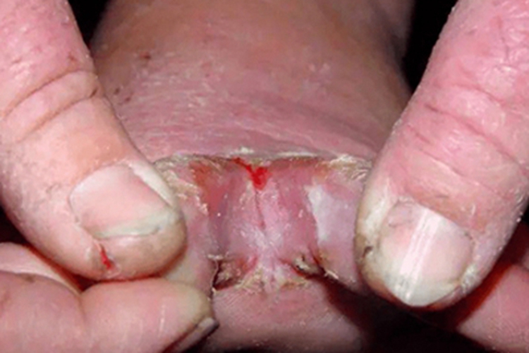 糜烂型足癣脚趾缝糜烂图