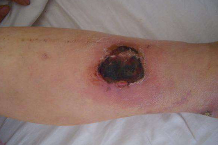 皮肤坏死结黑色硬壳图
