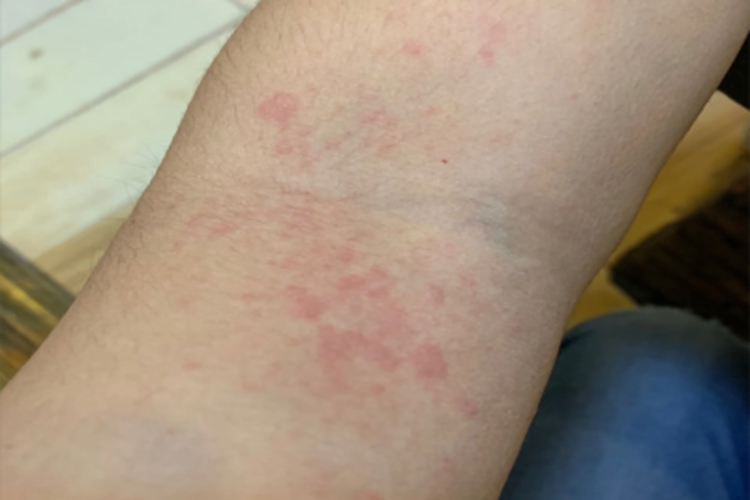 慢性自发性荨麻疹红点图