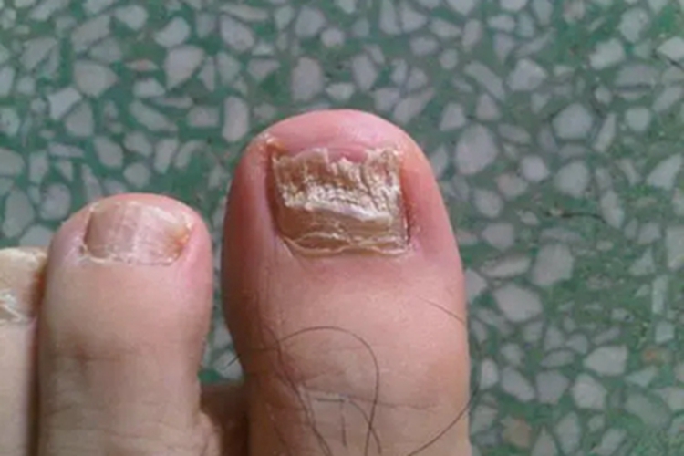 甲纵裂脚趾甲症状图