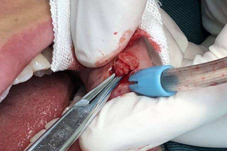 黏液腺囊肿图 黏液腺囊肿图