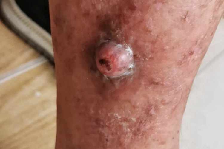 皮肤基底细胞癌小腿溃疡图 皮肤基底细胞癌小腿溃疡图