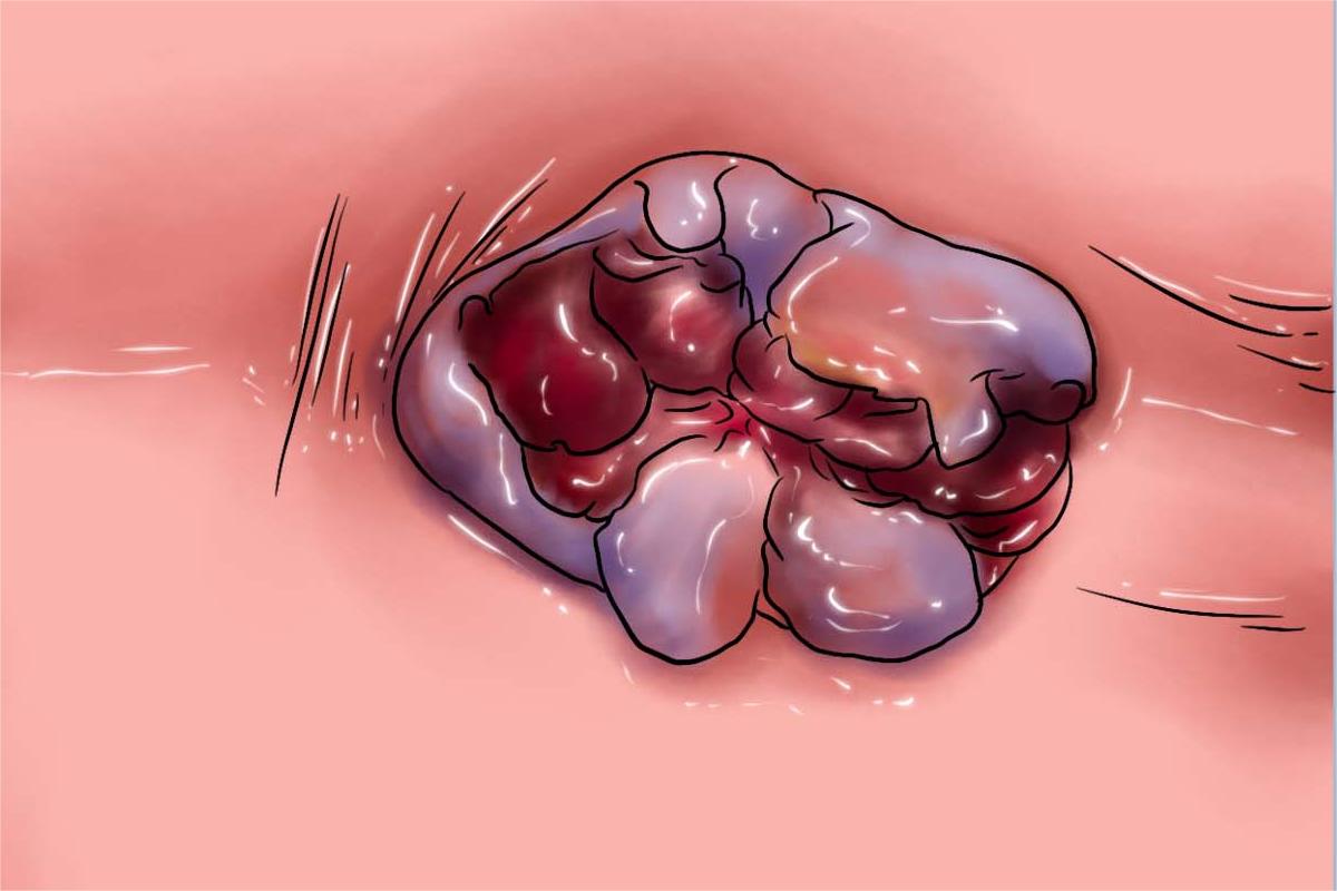 混合痔肛门症状手绘图