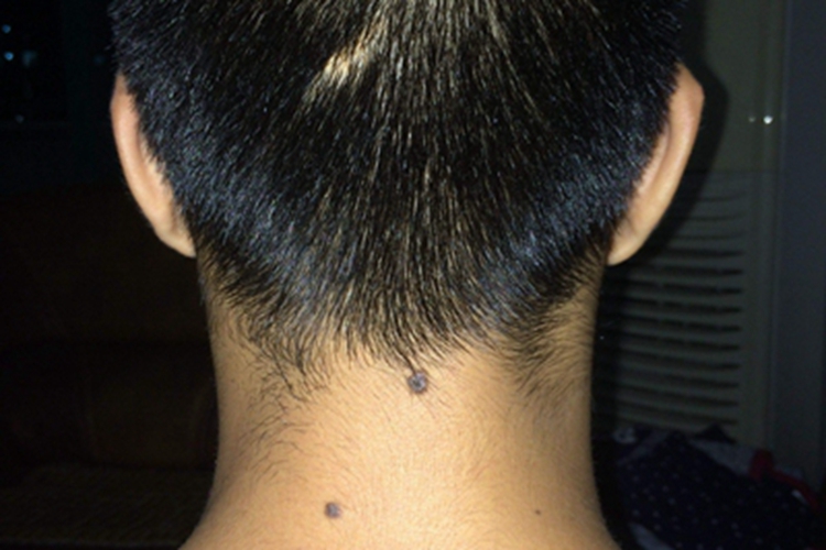 黑素细胞痣黑痣图片