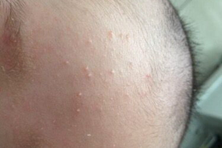 新生儿皮脂腺增生前额白点图