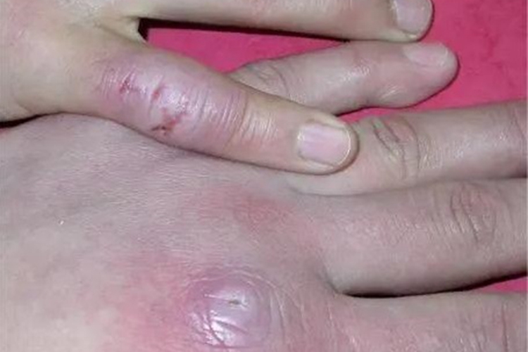 偶遇分枝杆菌感染手指红肿图
