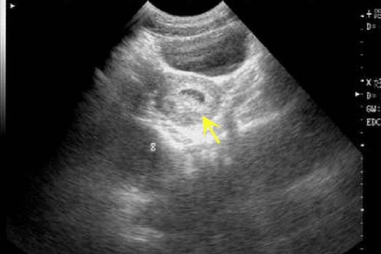 一个月左右孕囊B超图