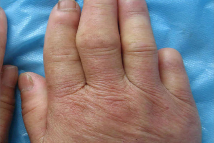 肢端硬化病手指供血不足图