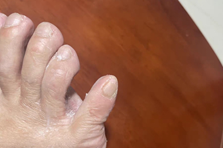足癣脚趾缝脱屑图
