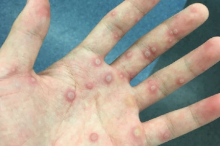 大人手足口病手部症状图