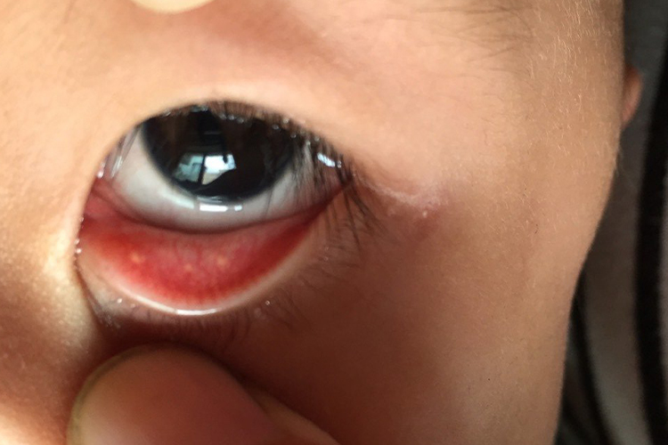 结膜结石下眼皮白色颗粒图