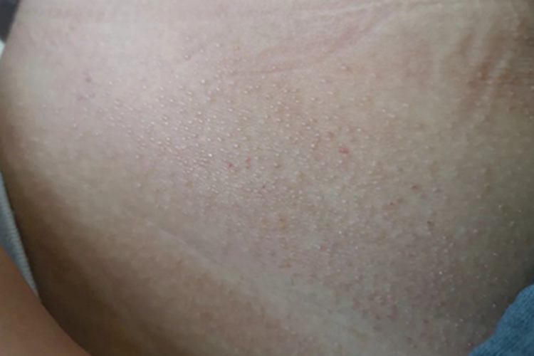 光泽苔藓腹部一片丘疹图