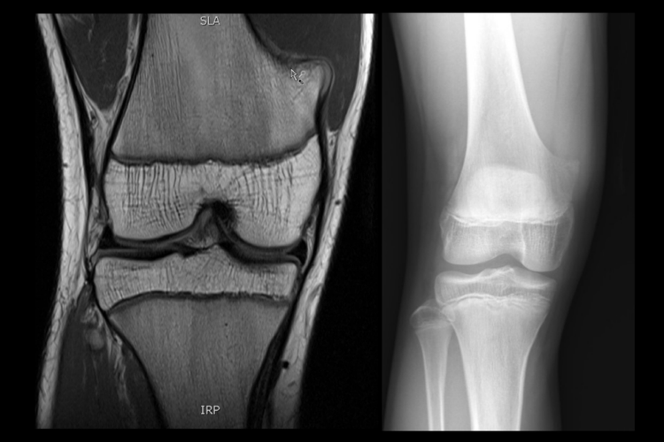 小孩骨软骨瘤影像图