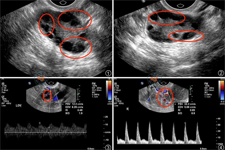 多囊卵巢综合征超声图