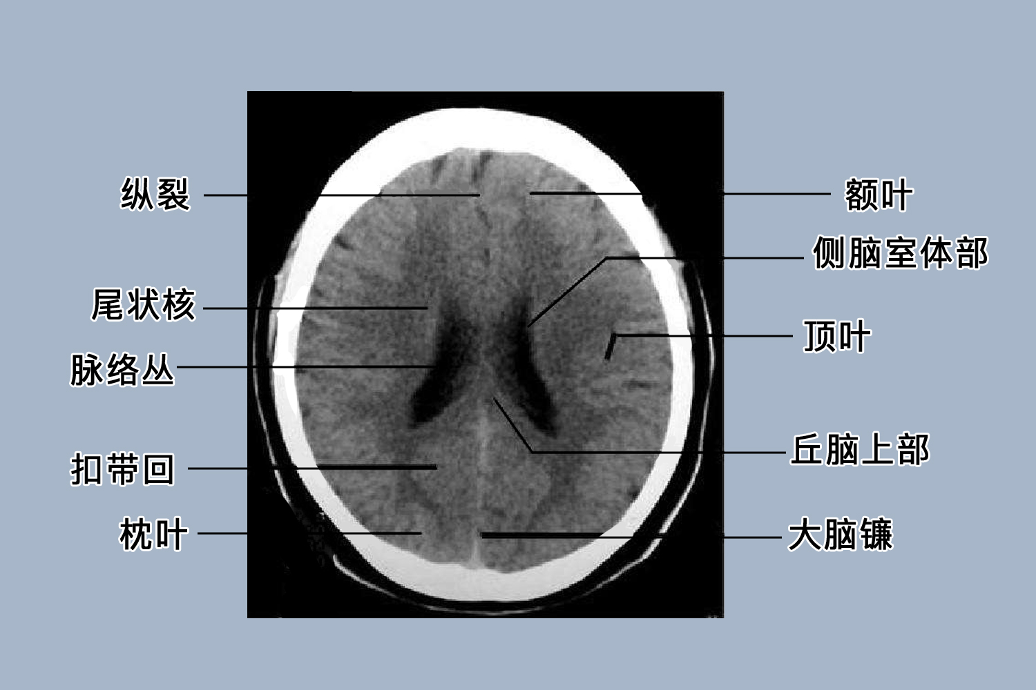 小脑蚓部正常影像解剖图片