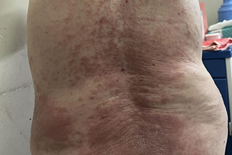 湿疹背部皮肤粗糙图 湿疹背部皮肤粗糙图