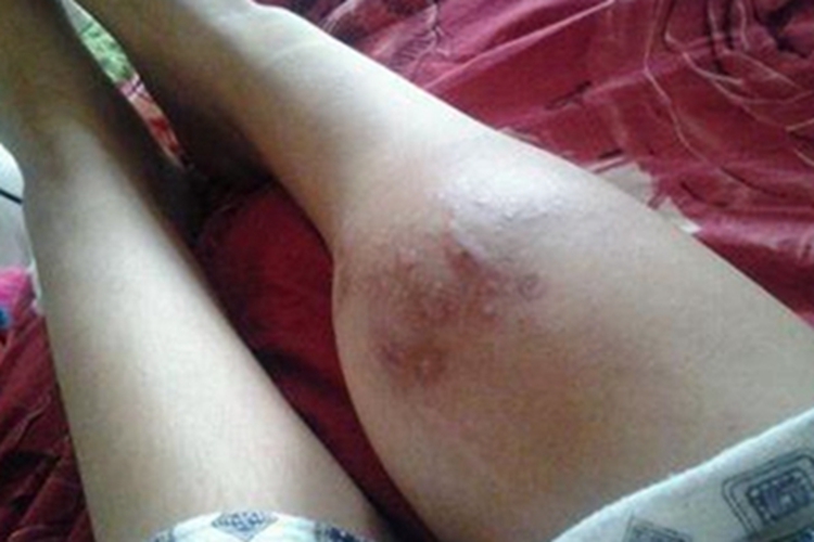 恶性纤维组织细胞瘤小腿症状图 恶性纤维组织细胞瘤小腿症状图