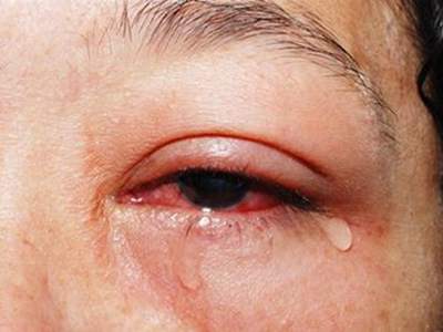 红眼病的症状和图片 