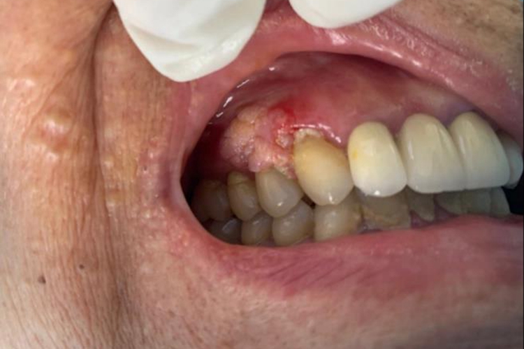 牙龈尖锐湿疣图