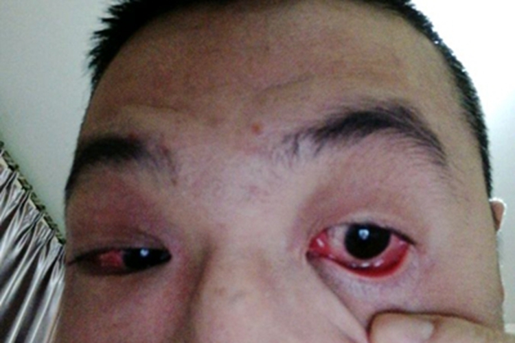 红眼病眼球和眼睑充血图