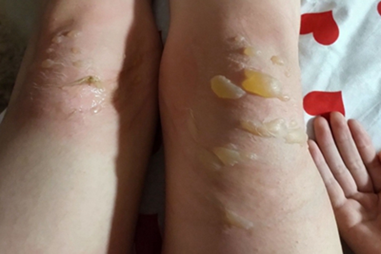 烫伤膝盖水疱图