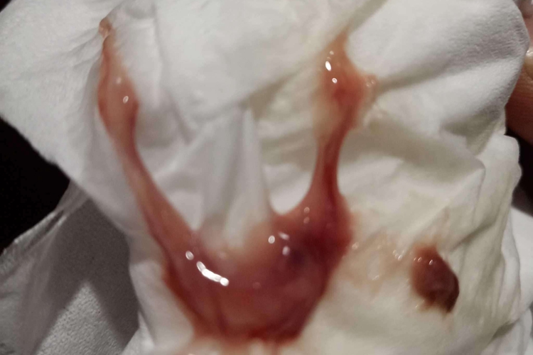 异位妊娠白带血丝图