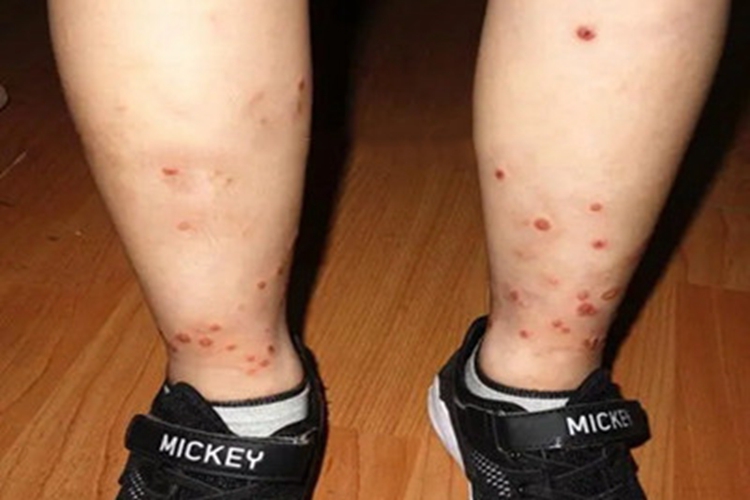 儿童期特应性皮炎小腿症状图 儿童期特应性皮炎小腿症状图