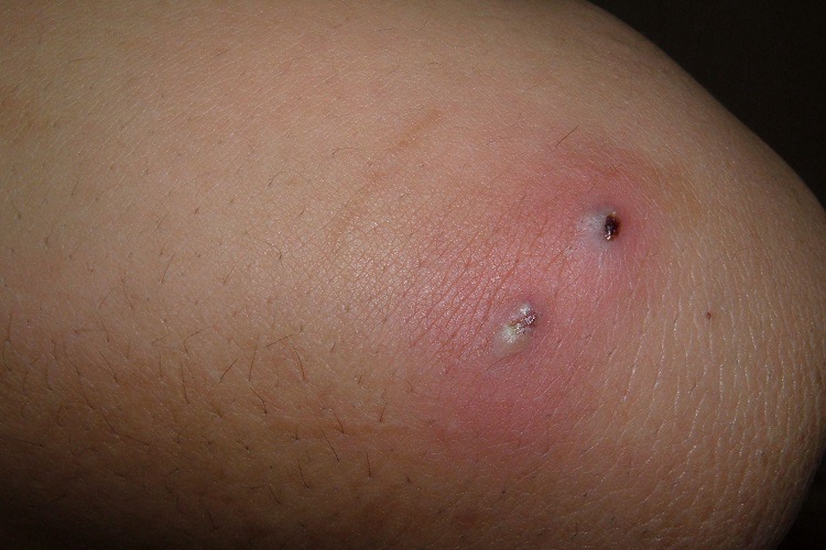 毛囊炎腿脓包图 毛囊炎腿脓包图