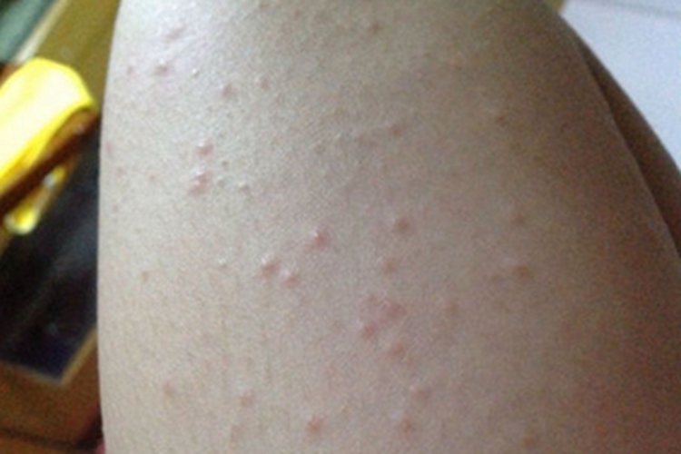 革螨皮炎大腿症状图 革螨皮炎大腿症状图