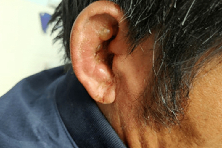 外耳湿疹耳廓皮肤形成水疱图 外耳湿疹耳廓皮肤形成水疱图