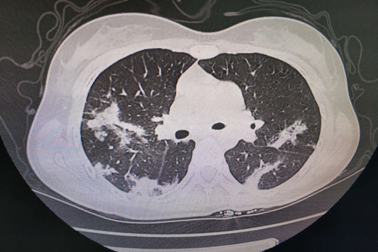 嗜酸性粒细胞性肺炎CT图