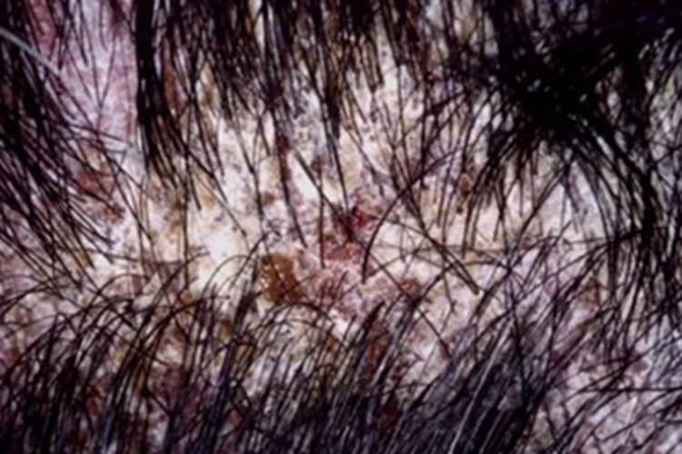 石棉状糠疹头皮有皮屑堆积图 石棉状糠疹头皮有皮屑堆积图