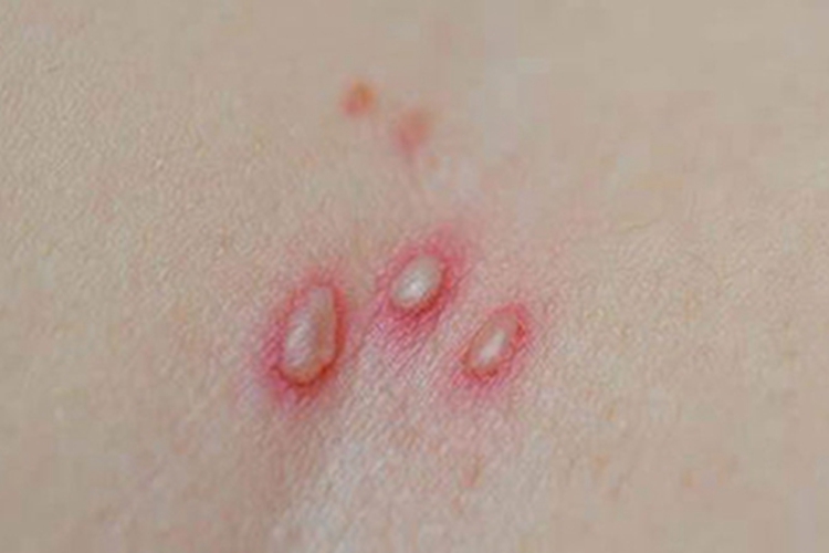 妊娠疱疹胸部水疱图