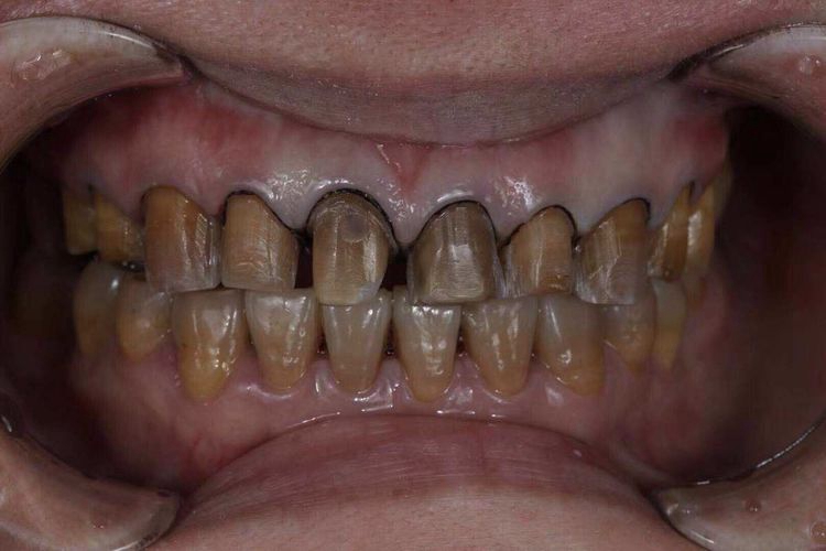 极重度四环素牙牙齿症状图