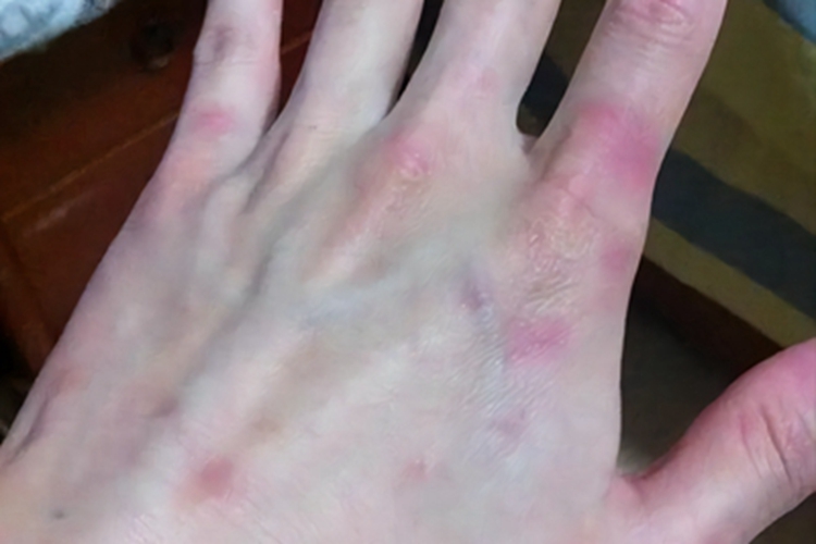 重症多形红斑手背症状图 重症多形红斑手背症状图