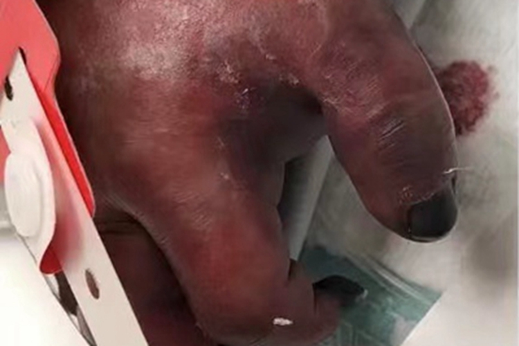 暴发性紫癜手部皮肤发紫图