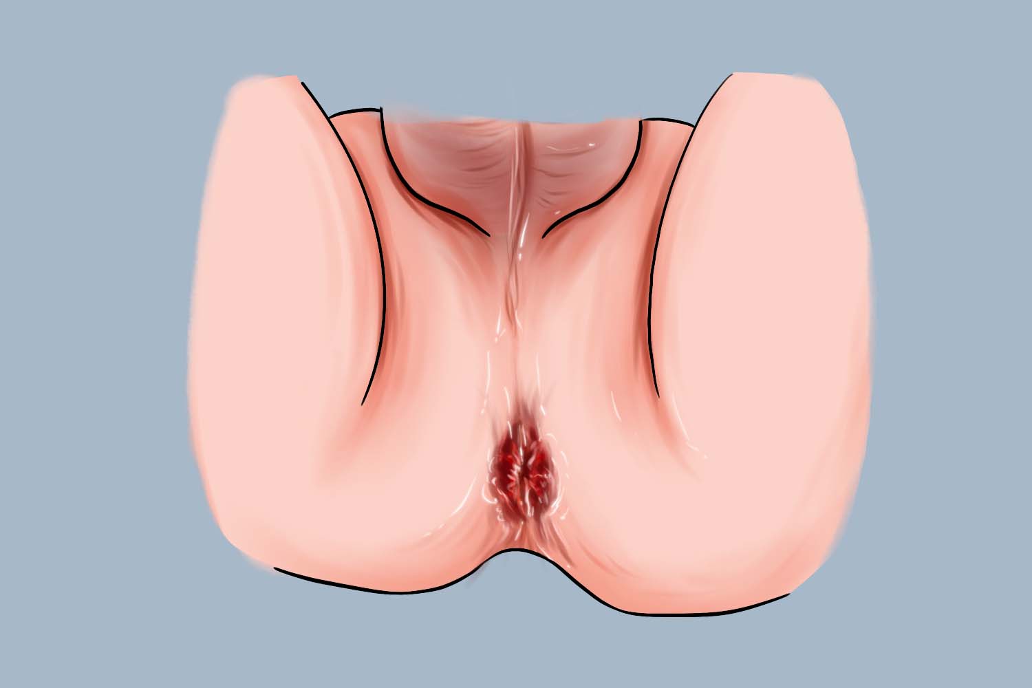 肛周梅毒树胶肿图 肛周梅毒树胶肿图