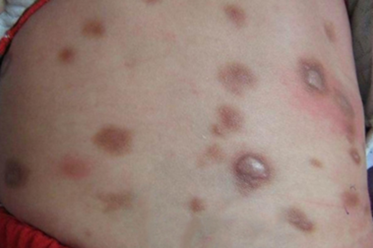 色素性荨麻疹症状图