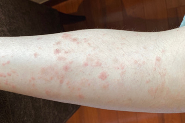 玫瑰糠疹小腿上红斑图 玫瑰糠疹小腿上红斑图