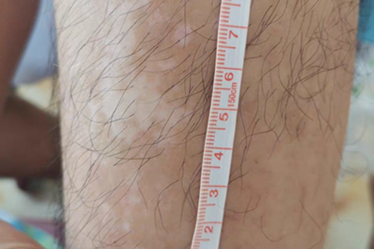 进展期节段型白癜风白斑图