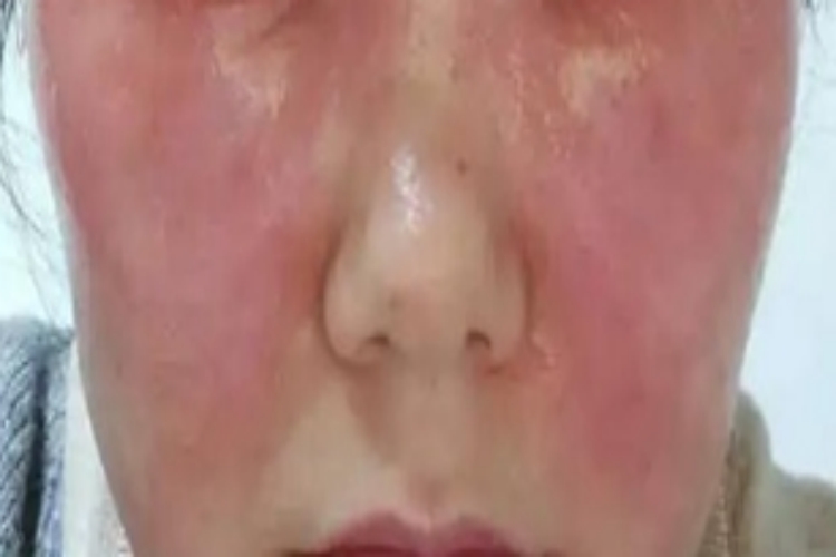 皮肤过敏红肿脸上水肿图