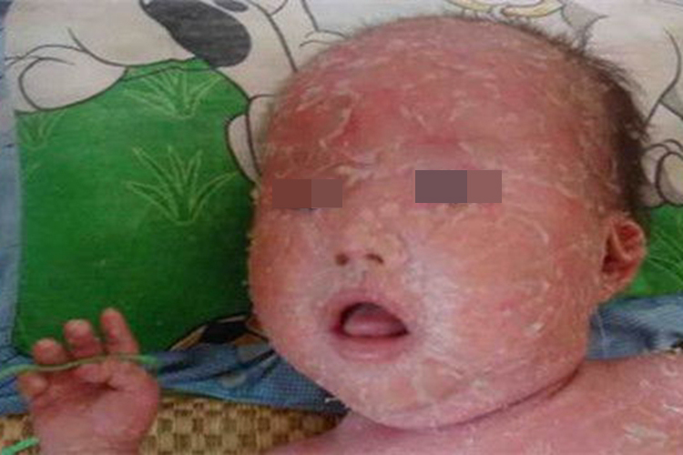 婴儿板层状鱼鳞病图 婴儿板层状鱼鳞病图