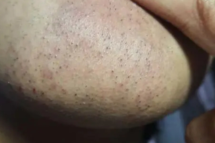 拔胡子黑色素沉淀图