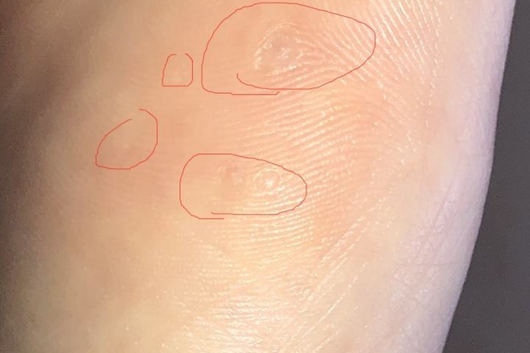 跖疣创面愈合图