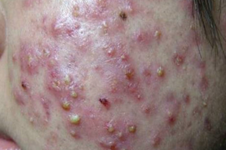 毛囊炎面部症状图