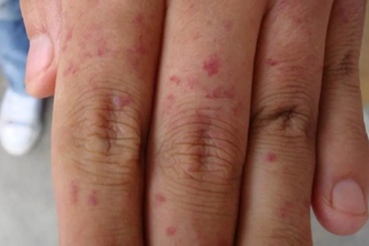 肢端血管角化瘤手指有紫点图