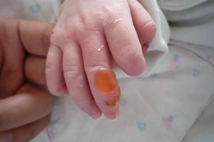 大疱性表皮松解症手指大疱图