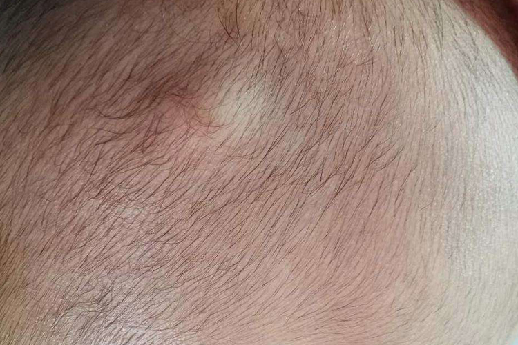 婴儿头部皮下囊肿可能为皮样囊肿,较少见,出生后即有或儿童期发病