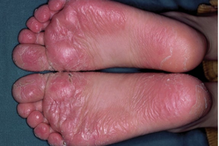 幼年性跖部皮病脚底红斑图