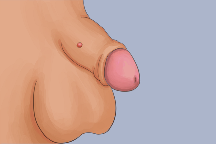 毛囊炎阴茎手绘图 毛囊炎阴茎手绘图